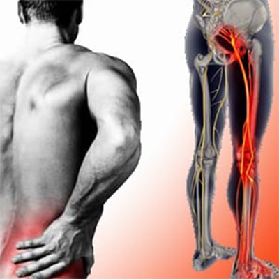 sciatica
